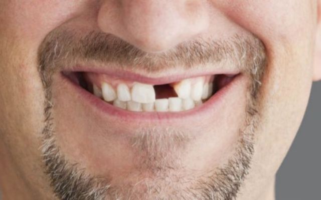 Nằm mơ thấy rụng răng cửa - Mẹo chọn số may mắn giúp bạn đổi vận ngay